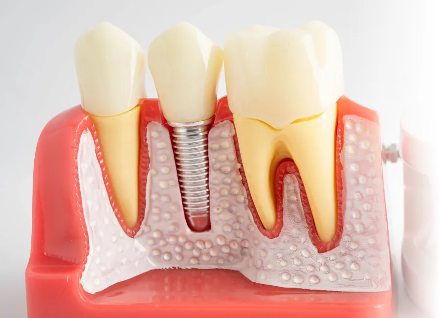 Dental Implants at Divine Dental in Santa Fe, NM 