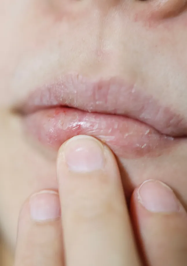 Dry Mouth Treatment at Divine Dental in Santa Fe, NM