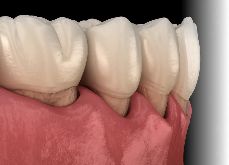 Gum Disease Evaluation at Divine Dental in Santa Fe, NM 