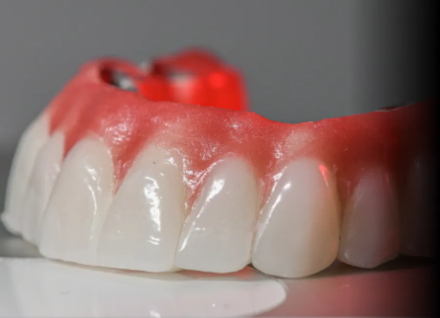 Dental Inlays And Onlays at [pracitice_name] in Santa Fe, NM