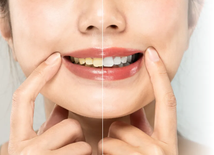 In Office Teeth Whitening at Divine Dental in Santa Fe, NM 